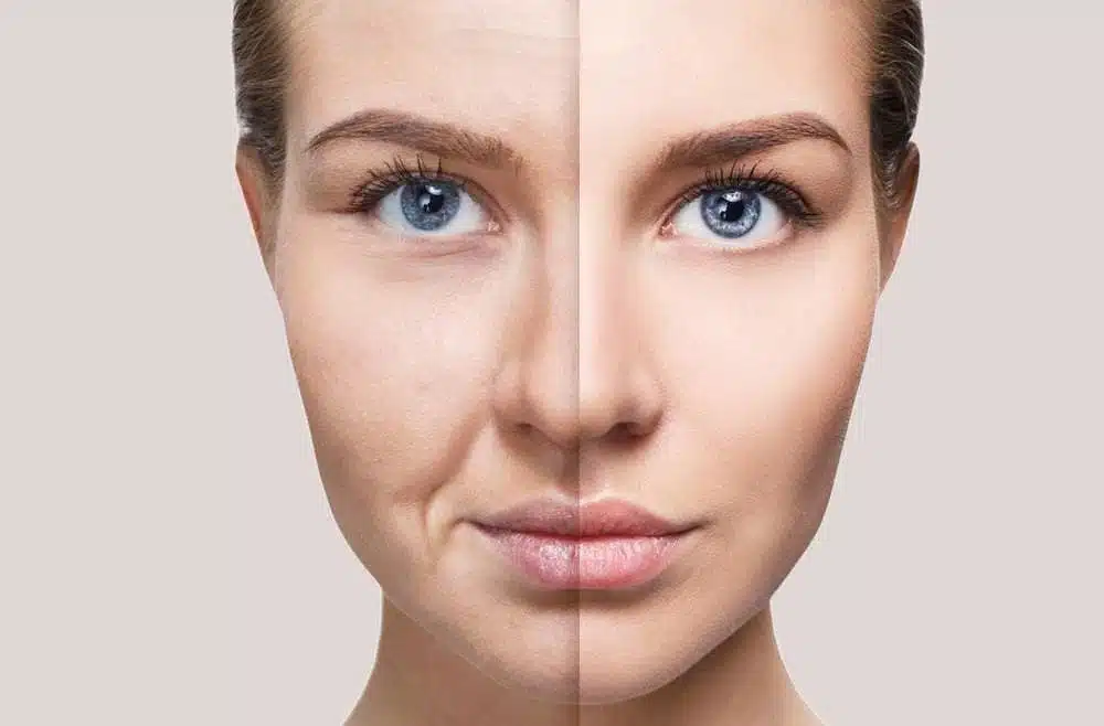 Perfect Skin antes e depois